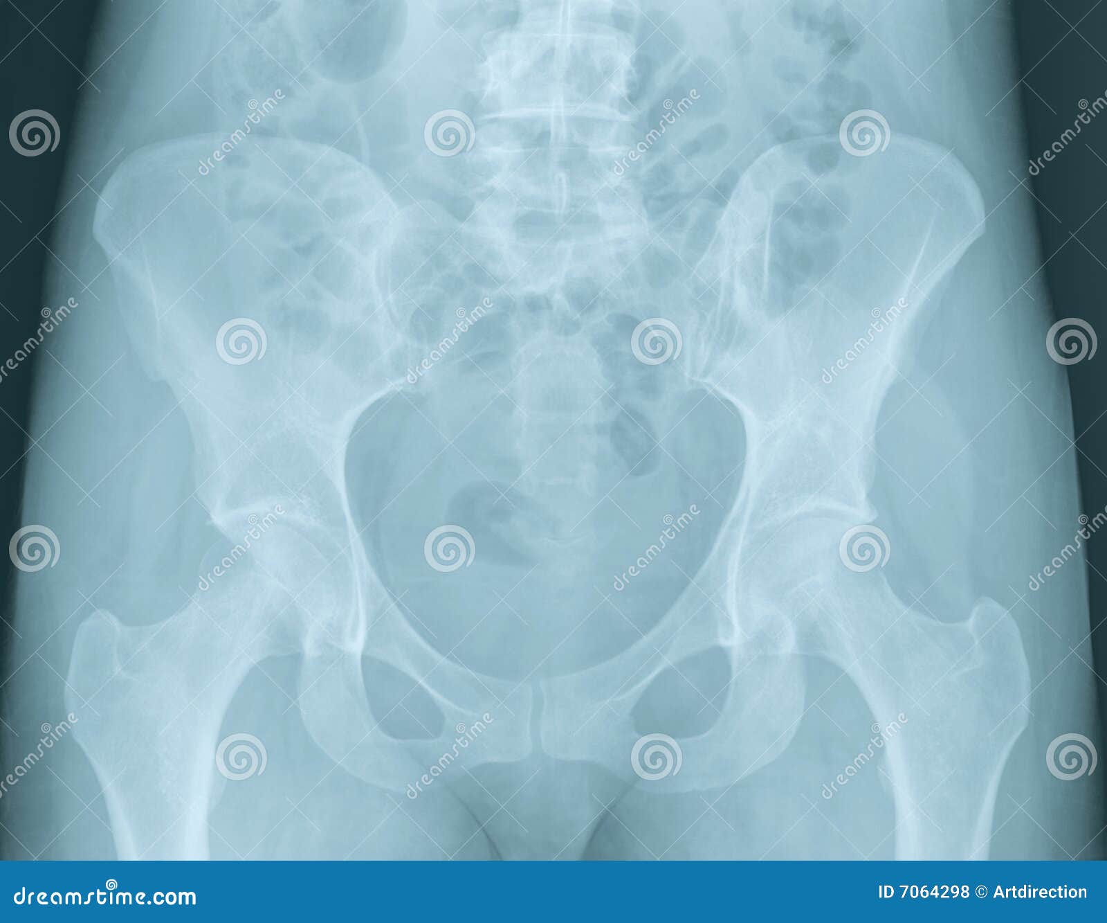 骨盆x光片分析（站立位），看片不求人~ - 知乎