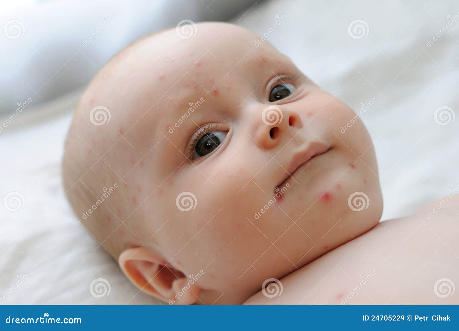 婴儿水痘初期症状图片（怎么判断是不是水痘）-幼儿百科-魔术铺