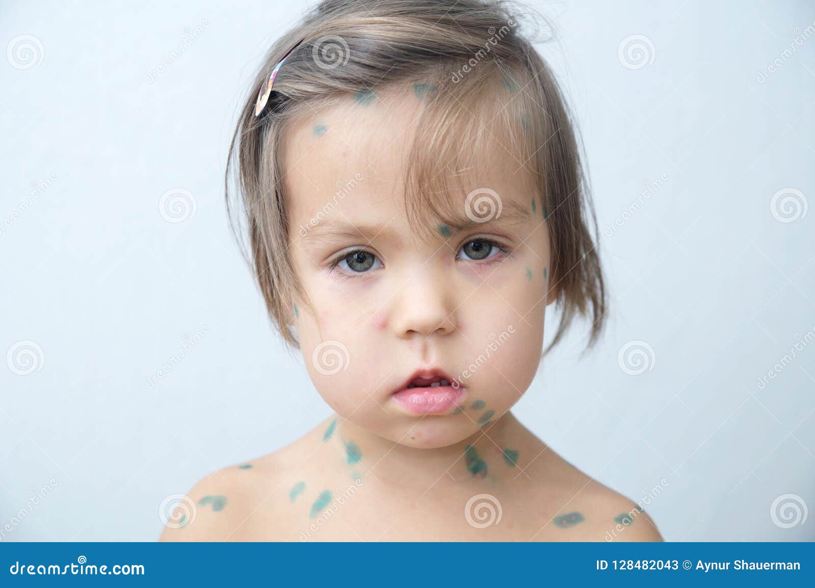 宝宝出水痘早期图片及症状（小儿水痘很凶险？注意，孩子出现这4种异常要警惕"中招"） | 说明书网