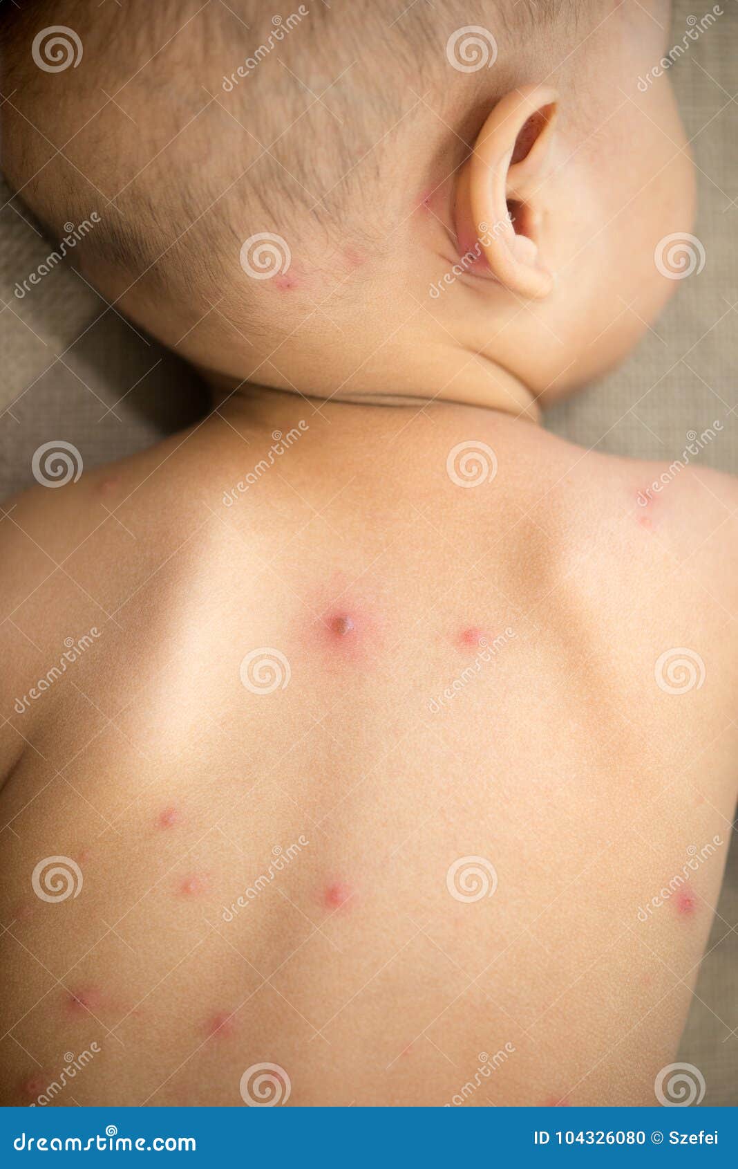 儿童水痘症状图片 初期水痘图片真实→MAIGOO图库