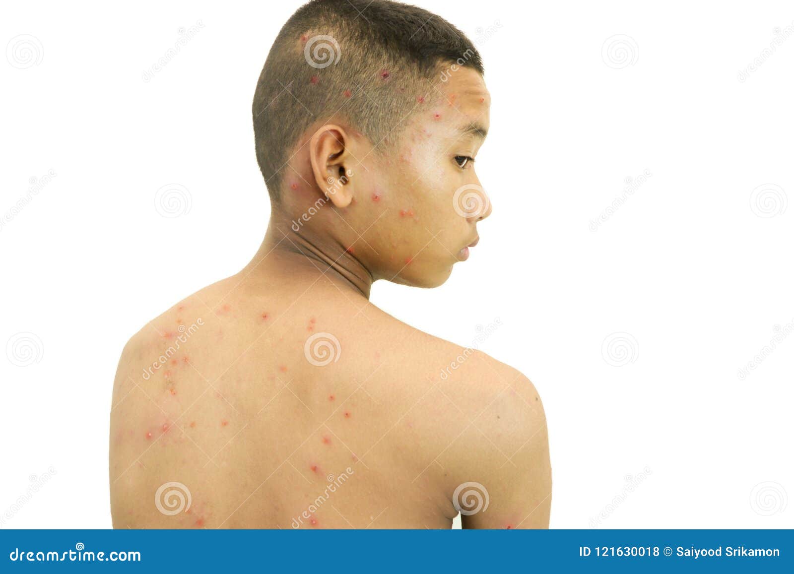 幼儿急疹、麻疹、川崎病、水痘、风疹，如何识别不同皮疹？_澎湃号·湃客_澎湃新闻-The Paper