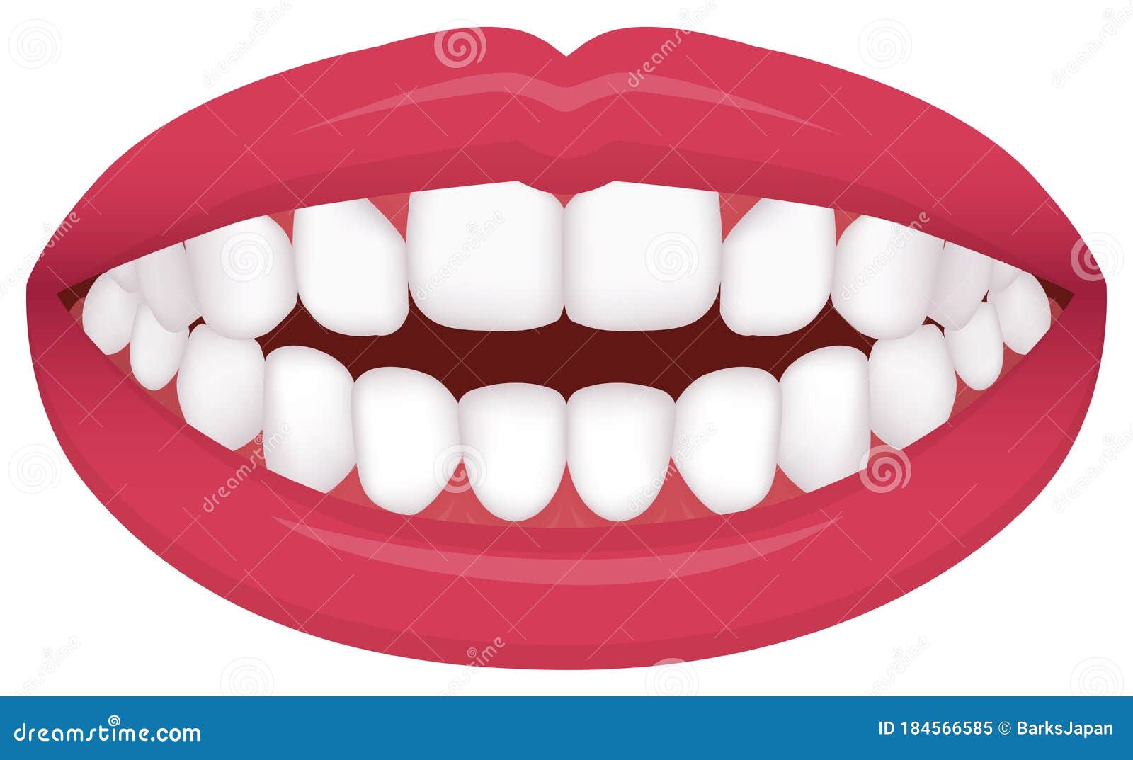 蛀牙的形成过程图片素材-编号39517357-图行天下