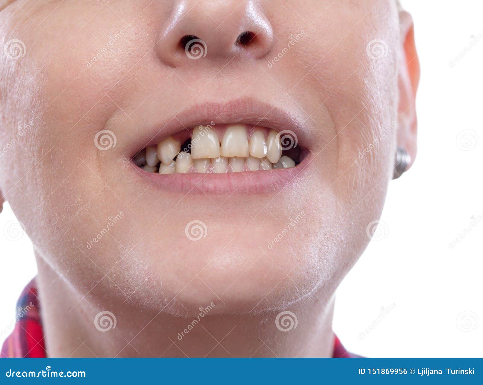 一个牙断的男子的肖像 库存照片. 图片 包括有 牙科医生, 关心, 表面, 腐朽, 问题, 经纪, 滴下 - 220791724