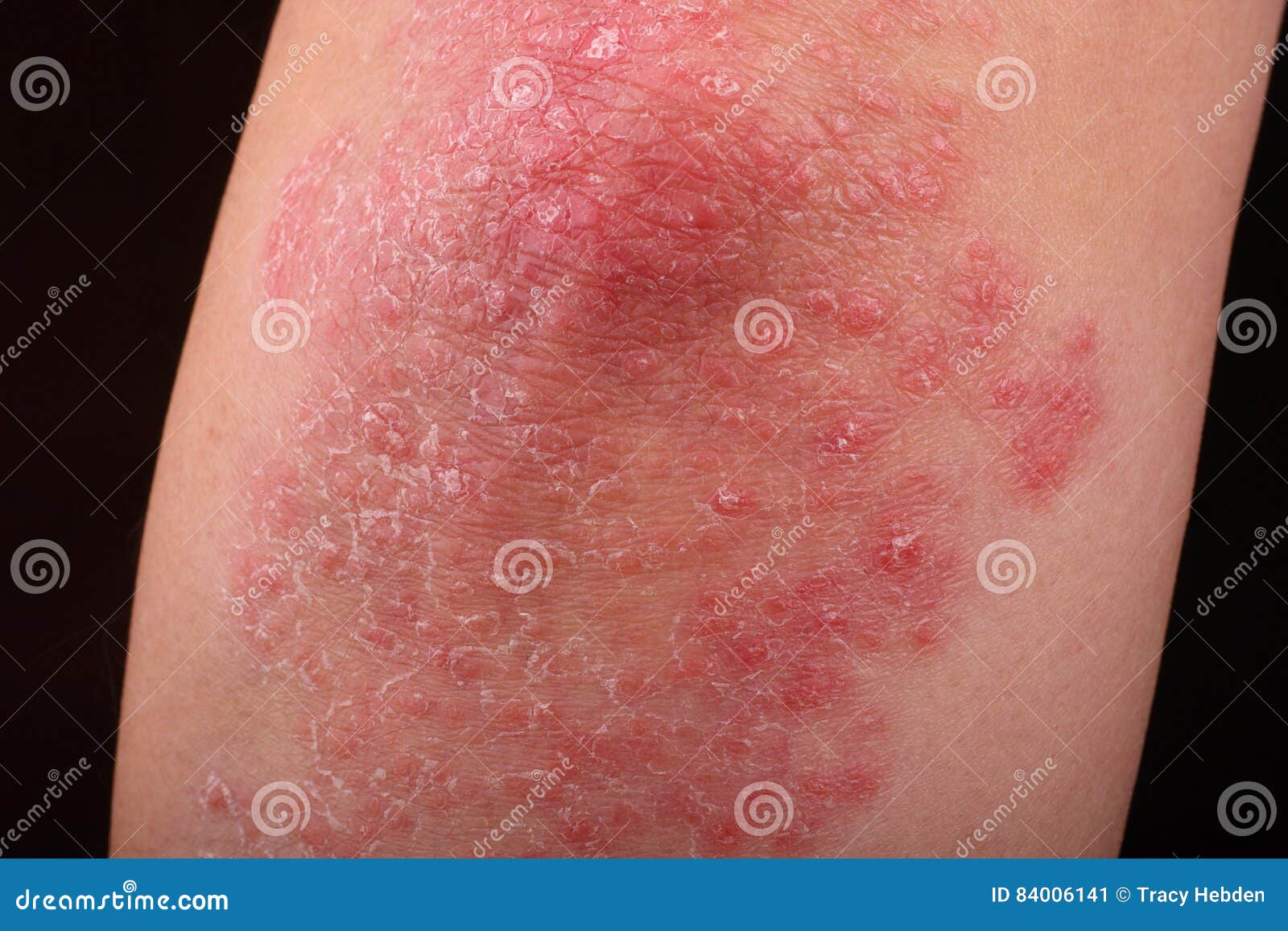 牛皮癣皮肤 牛皮癣是影响鳞状皮肤原因皮肤的炎症红色和的一个自体免疫病 湿疹 库存照片 - 图片 包括有 现有量, 刺耳: 111841588