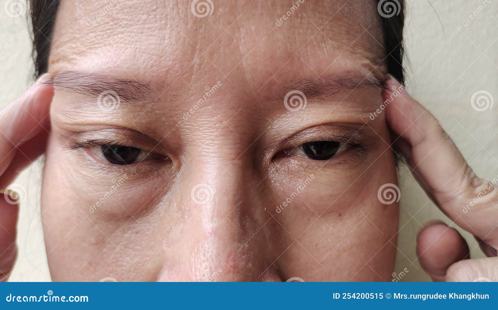 【讨论】一例伴有上睑凹陷和上睑松弛的双眼皮术式选择 - 修复重建和烧伤整形 -丁香园论坛