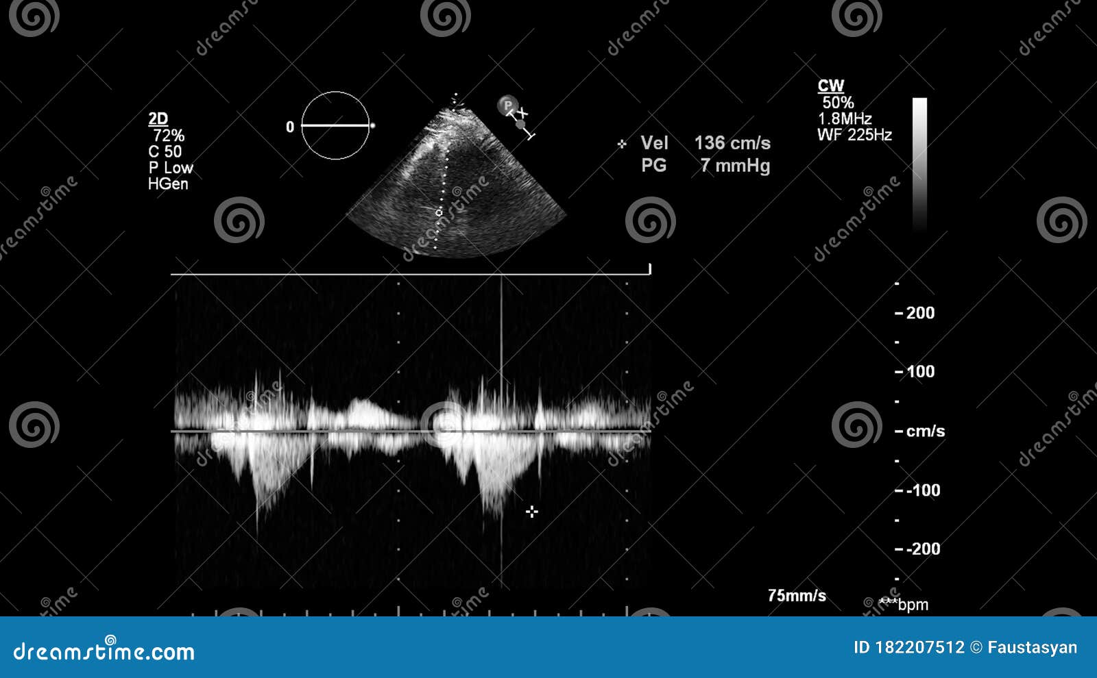 FDA 批准首个AI全自动心脏超声解决方案来测量 2D 和多普勒超声心动图 - 知乎