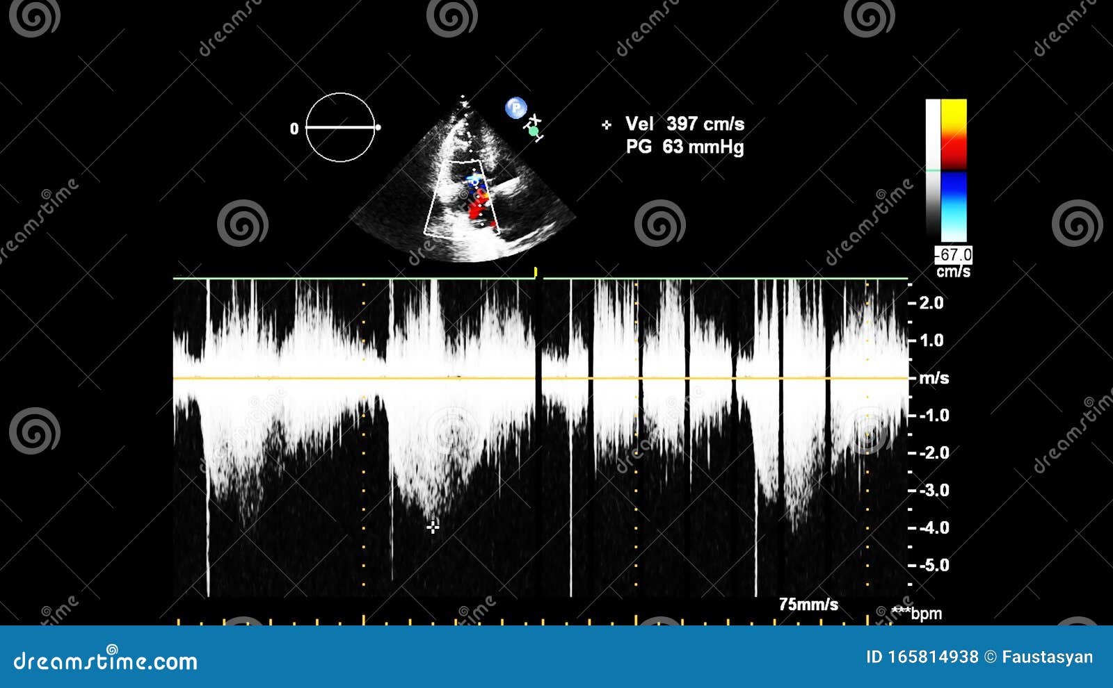 经食管超声下灰度型心脏影像学 — 图库照片©Faustasyan＃369919864