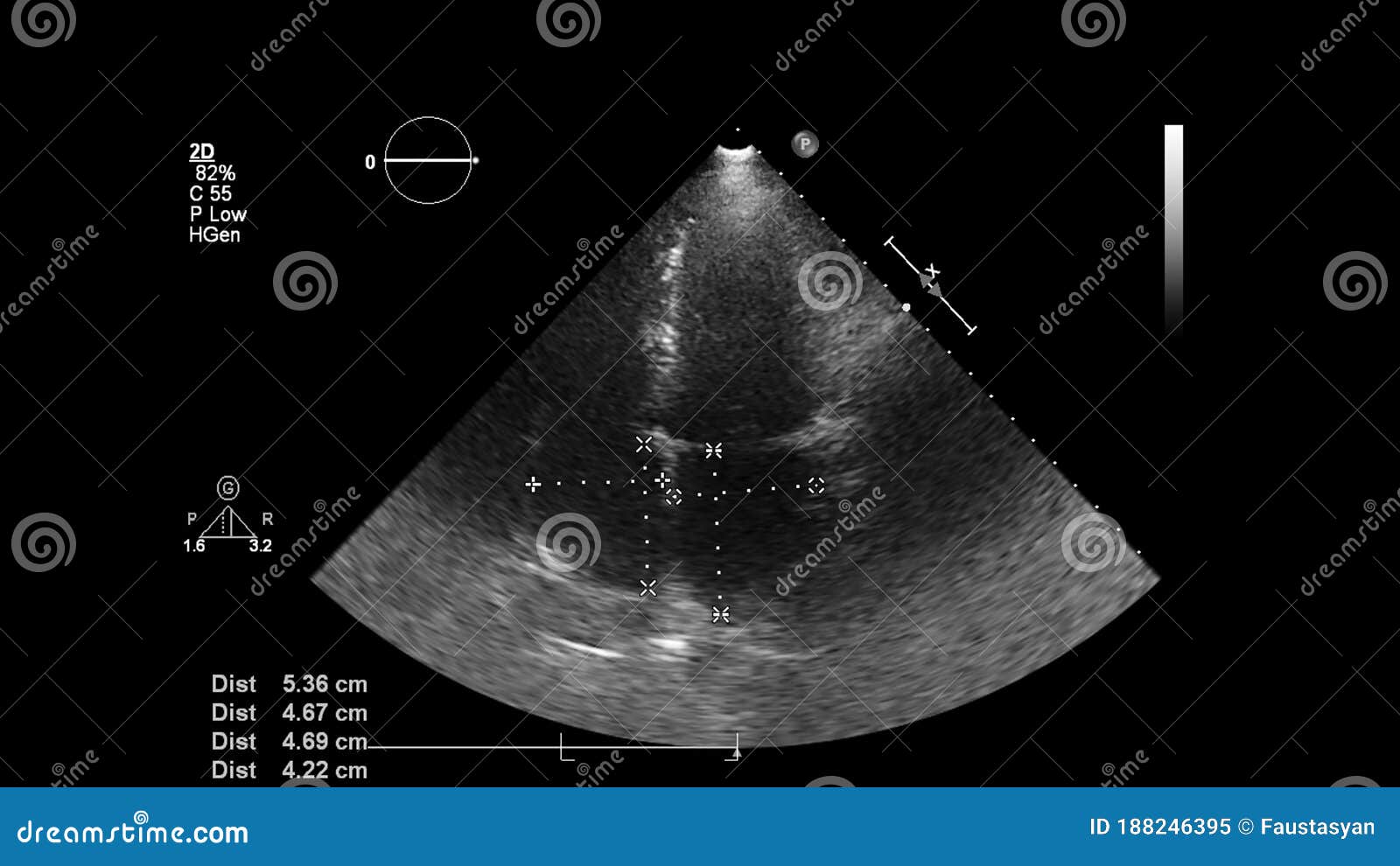 经食管超声心脏的影像学 库存图片. 图片 包括有 多谱勒仪, 患者, 医疗, 商业, 作用, 的闪烁, 量化 - 188246407