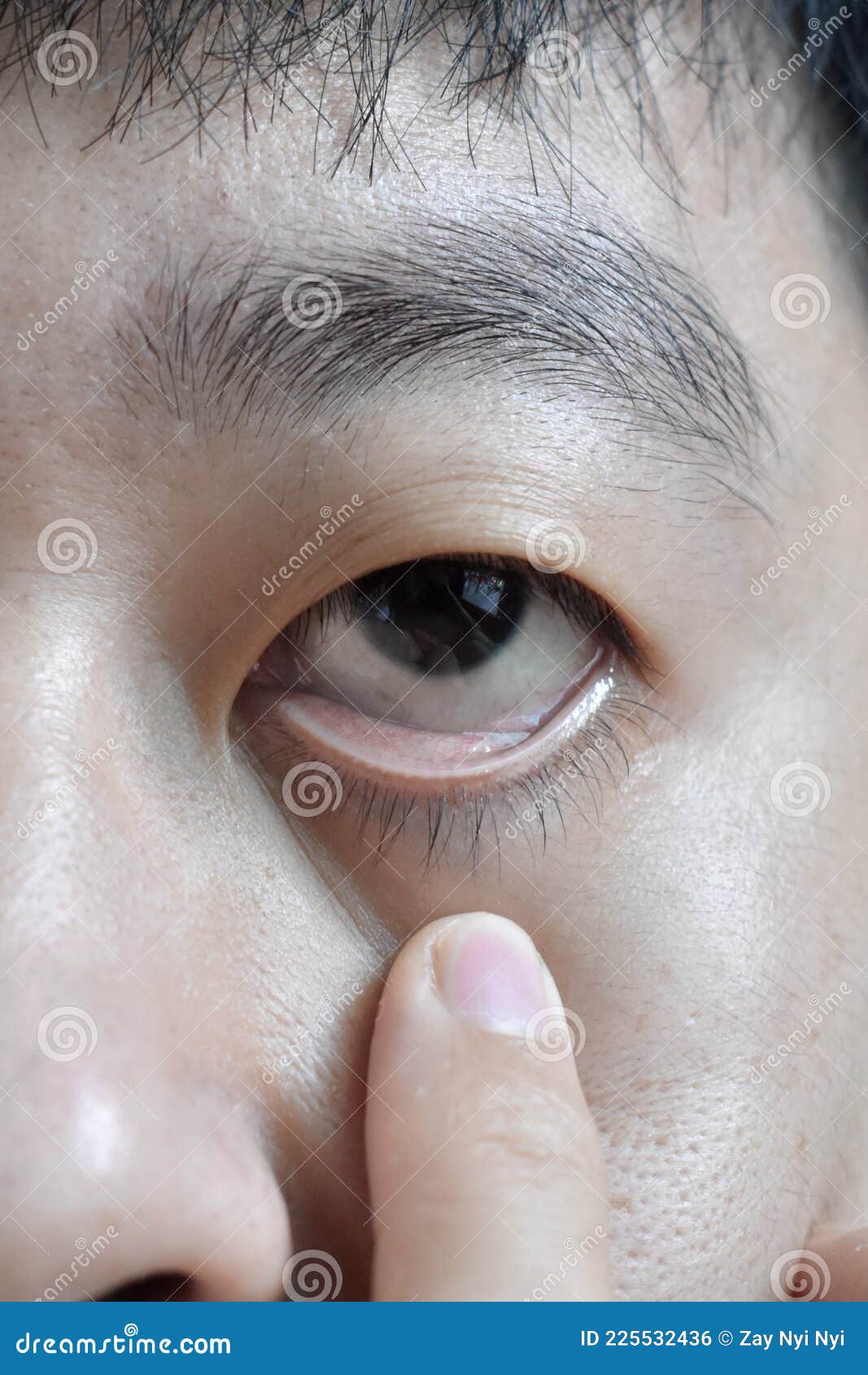 亚洲人的肤色苍白. 贫血症. 眼睑苍白 库存照片. 图片 包括有 表面, 严重, 紊乱, 符号, 面部 - 225486938