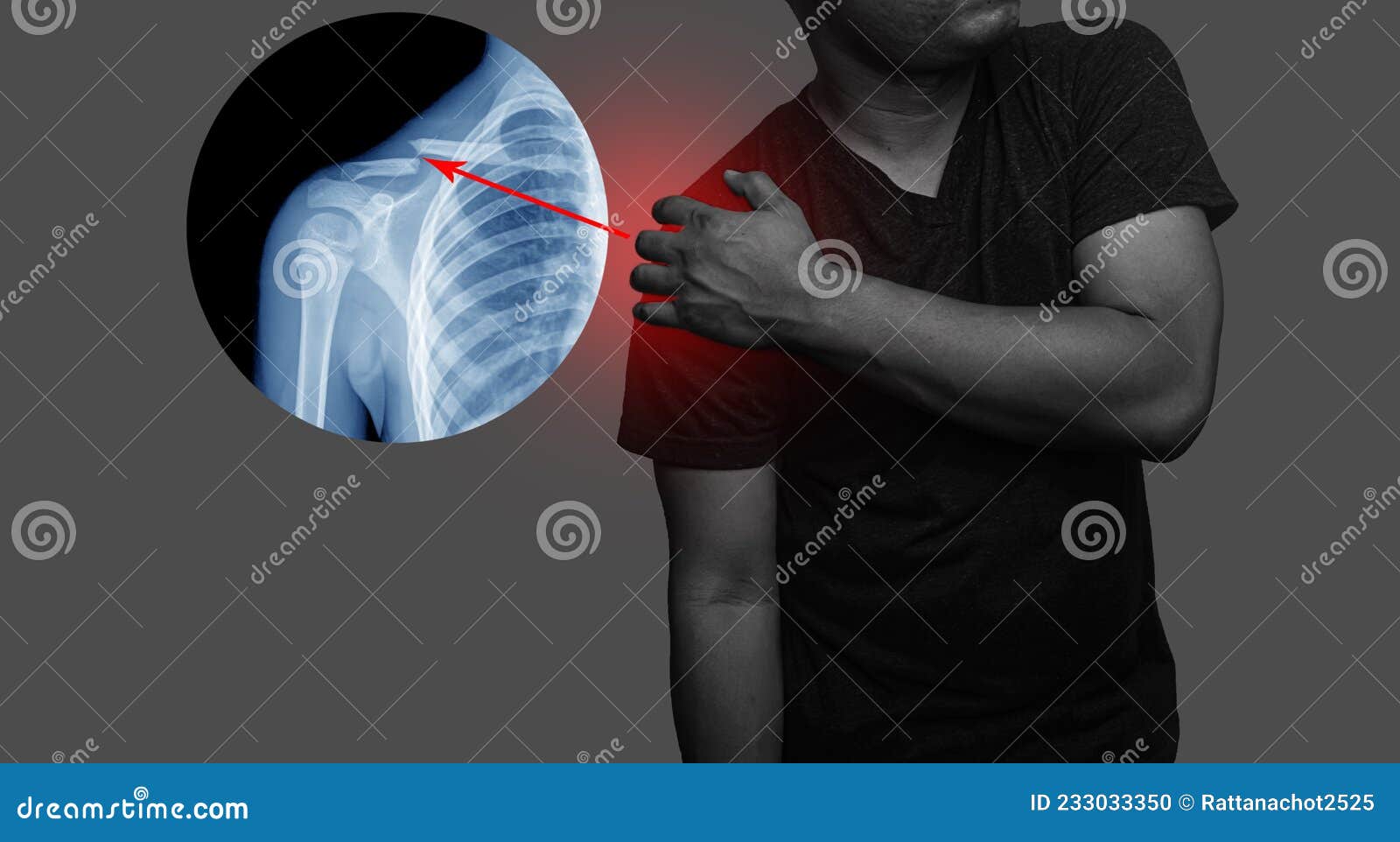 拇指肌腱-镇痛注射技术-图片