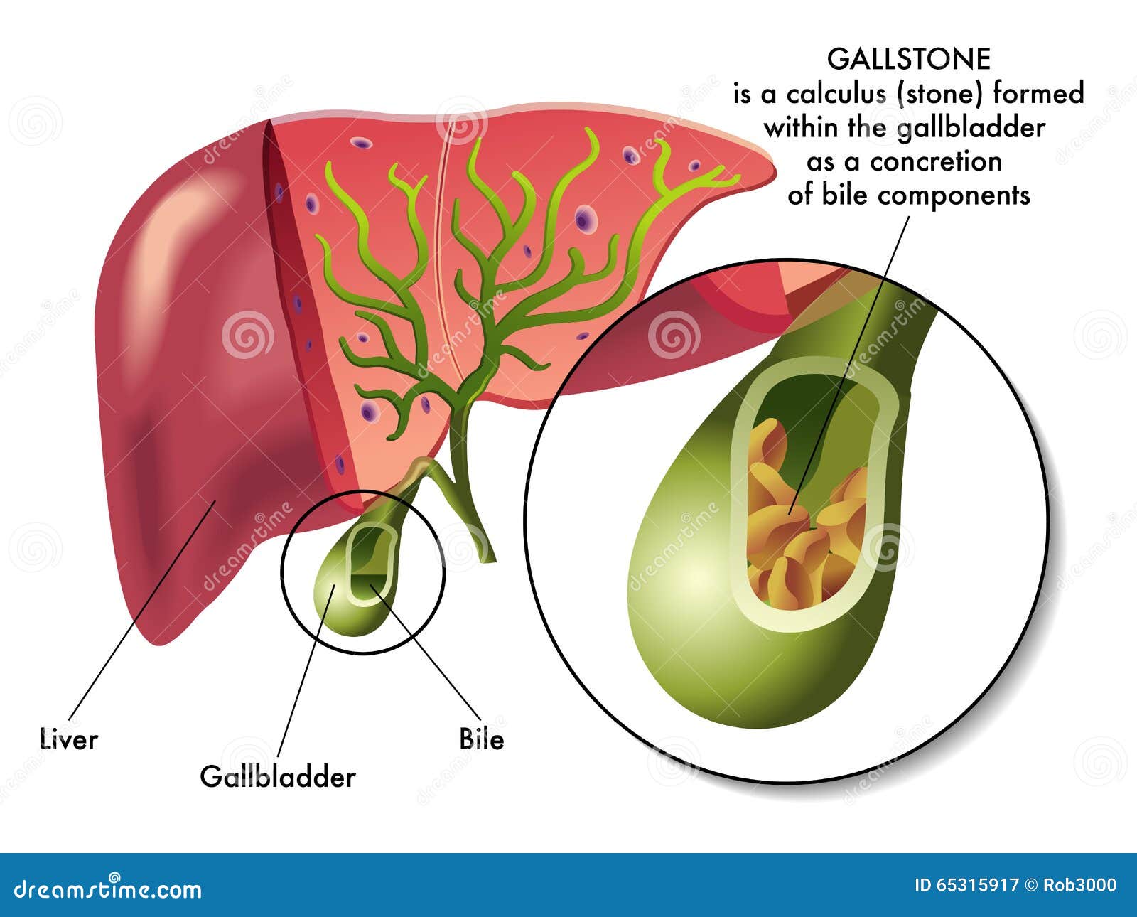 胆石症 Gallstones 胆结石 - 知乎
