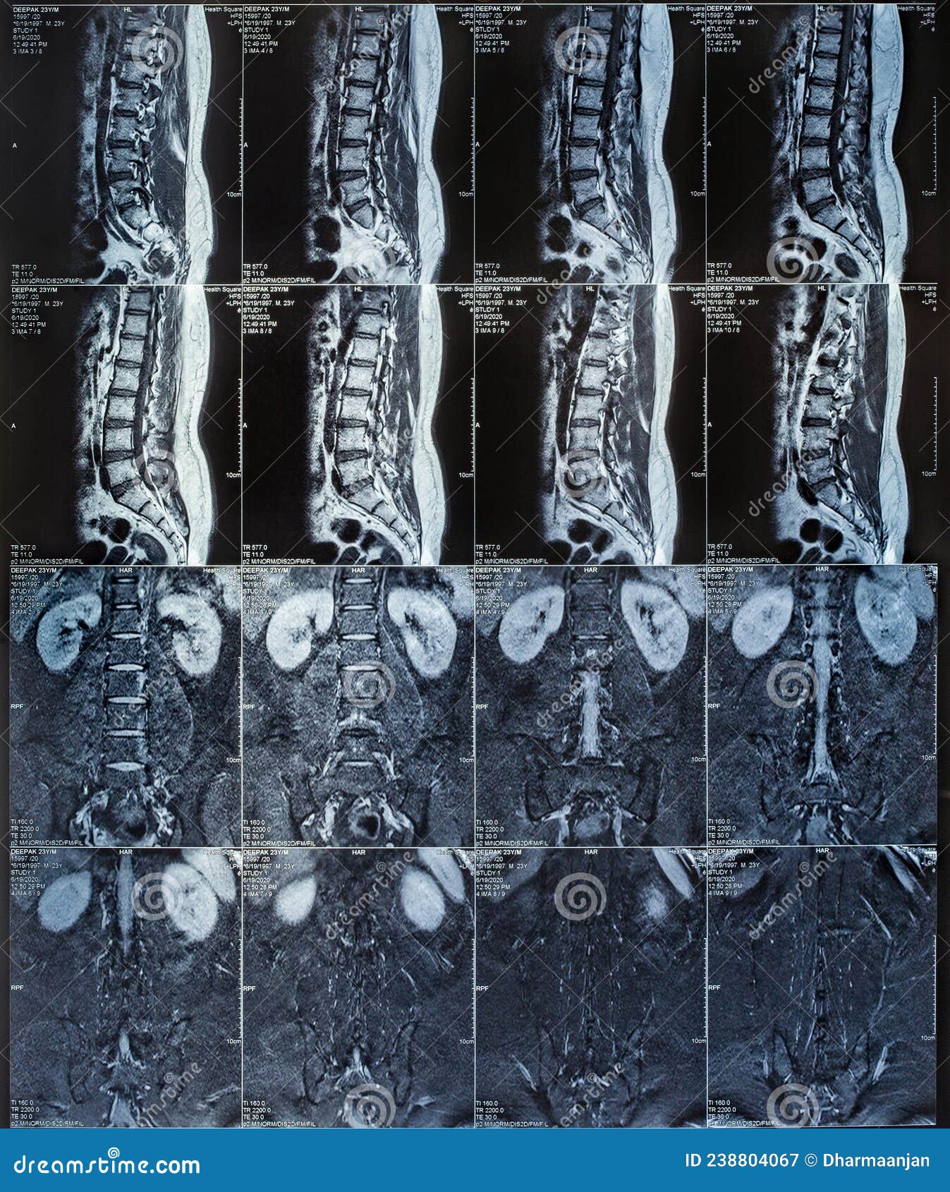 请放射科的老师看看这个腰椎核磁共振的片子 - 医学影像学讨论版 - 爱爱医医学论坛