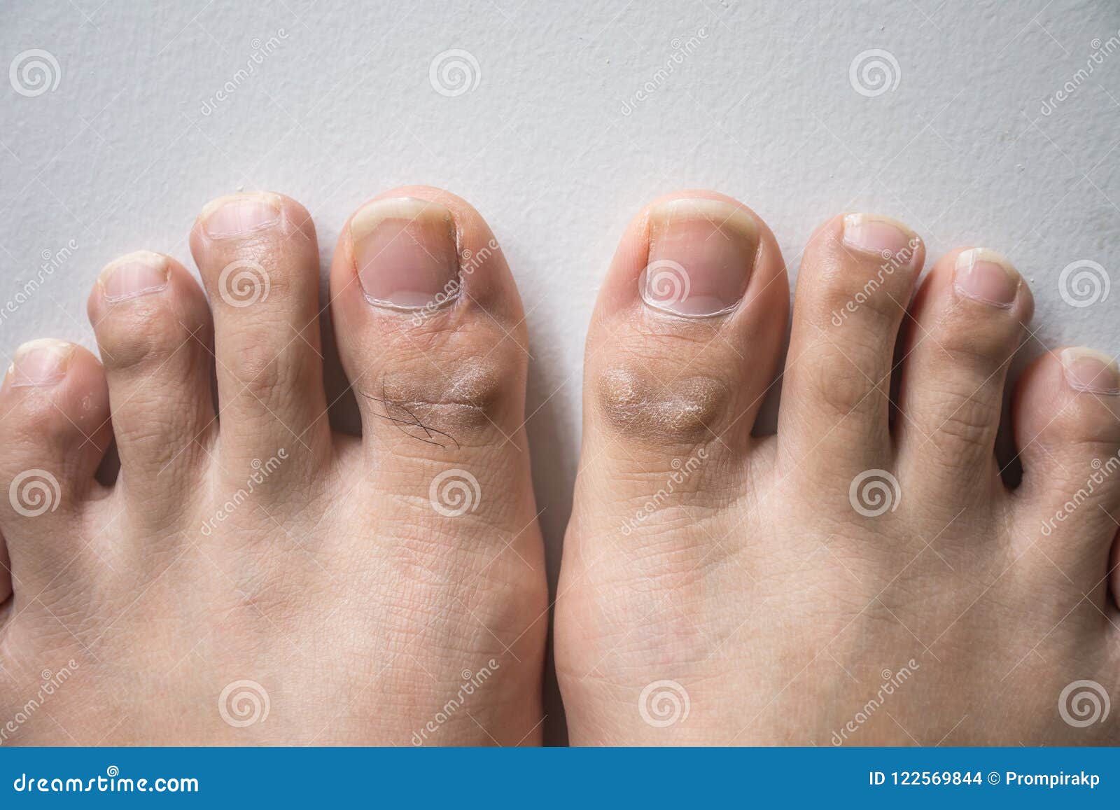 在脚趾钉子的真菌 库存照片. 图片 包括有 创伤, 情况, 无耻的, 脚病学, 空白, 健康, 医学, 问题 - 107198182