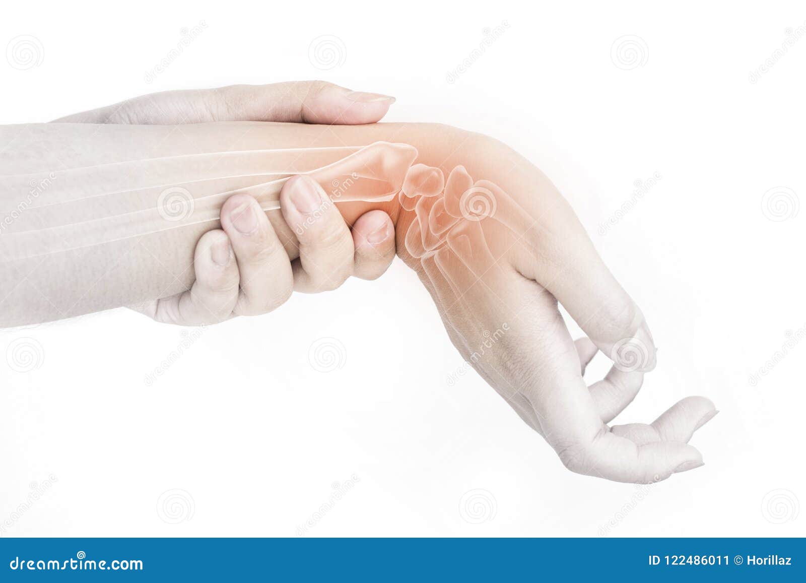 手麻警惕腕管综合征，这些人群高发，2个自测动作，能快速识别|腕管综合征|麻木感|肌电图|手麻|警惕|-健康界