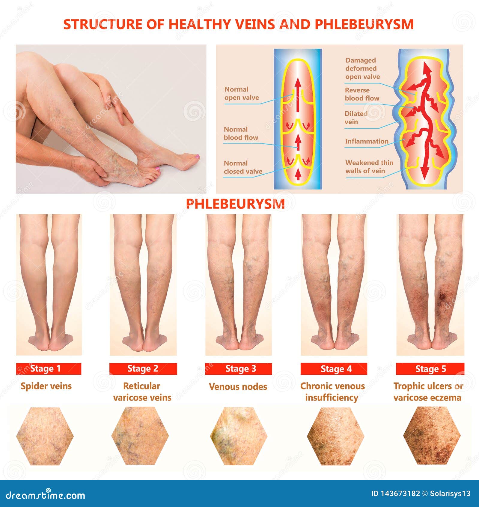 血栓 é ™è„‰æ›²å¼ å ¯ä»¥æ ‰ä¹ˆ 60å² é⃜¿å§¨æ ‰å‡ºè¡€æ “ æ­£ç¡®æ²»ç—æ¹æ³