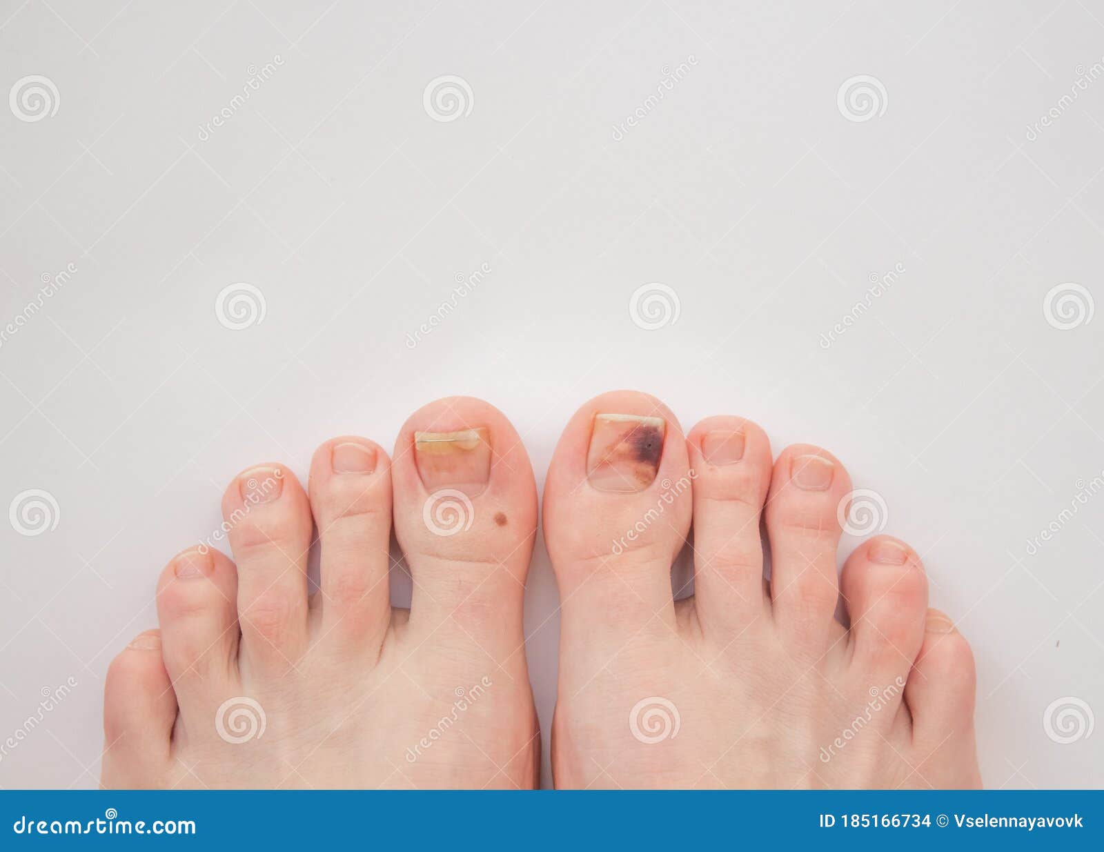 脚和长的钉子在白色具体背景用脚尖踢 库存照片. 图片 包括有 真菌, 皮肤, 手指, 关心, 背包, 传染 - 122569844