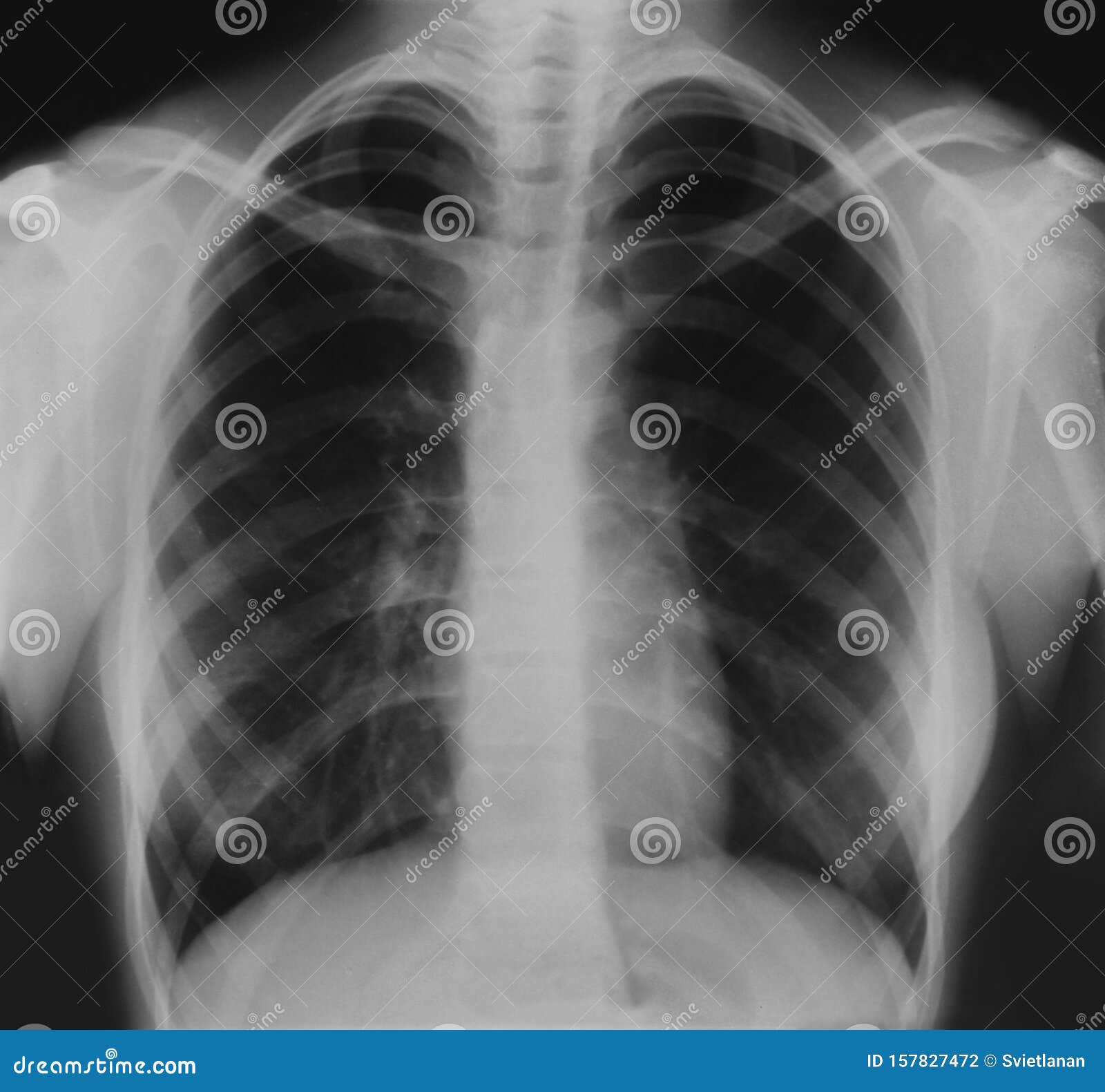 X射线肺炎图像的检测（Detecting Pneumonia in X-Ray Image） - 灰信网（软件开发博客聚合）