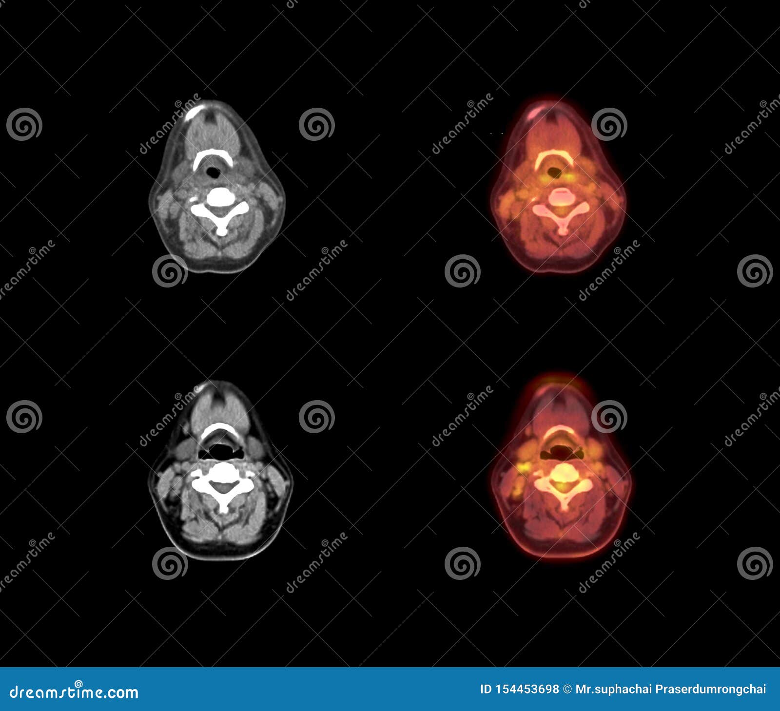 影像读片（47）：颈内动脉未发育（先天缺如）的DSA/CT/管壁MRI诊断表现